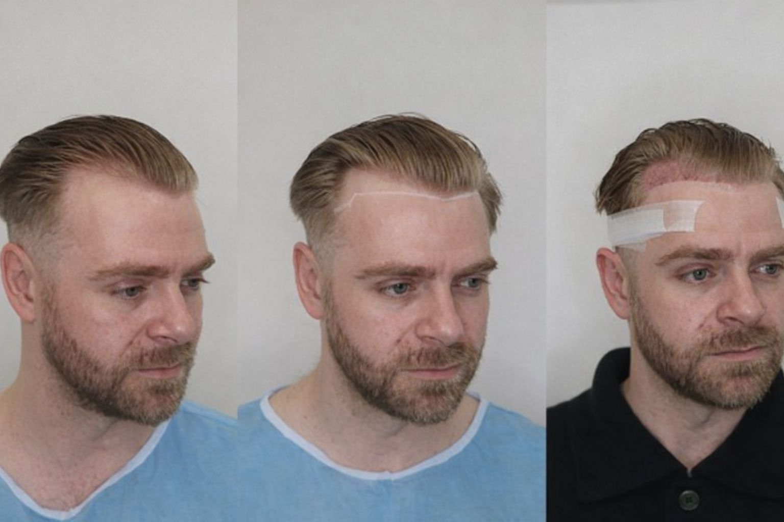 Tre billeder af en mand før, under og efter hårtransplantation forfra.