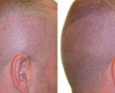 Før og efterbillede af barberet hovedbund med hårtransplantation.